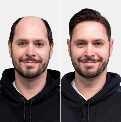 Mens Hair Systems UK Cost - London Hair Replacement