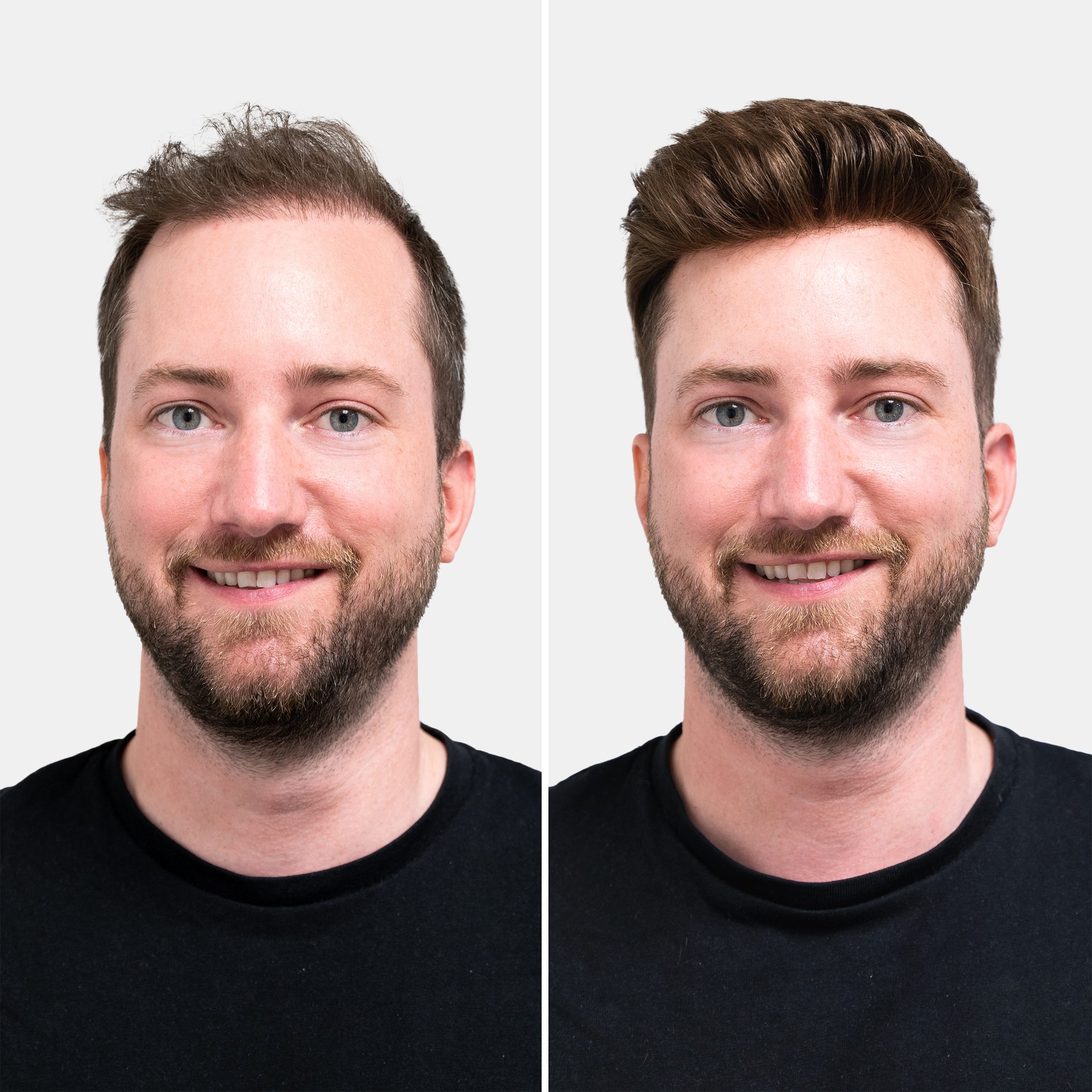 Hair Replacement in London