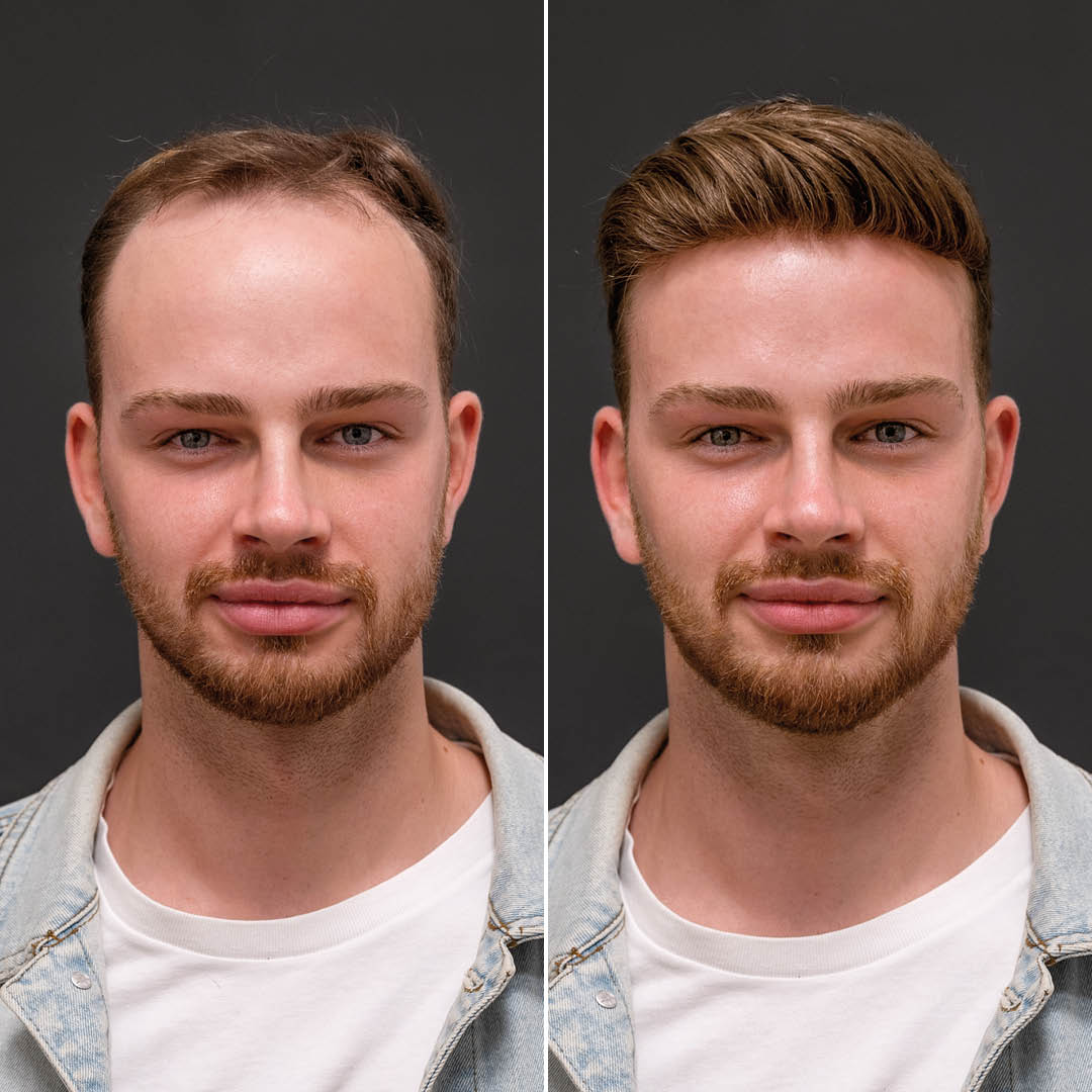 Hair Replacement in London