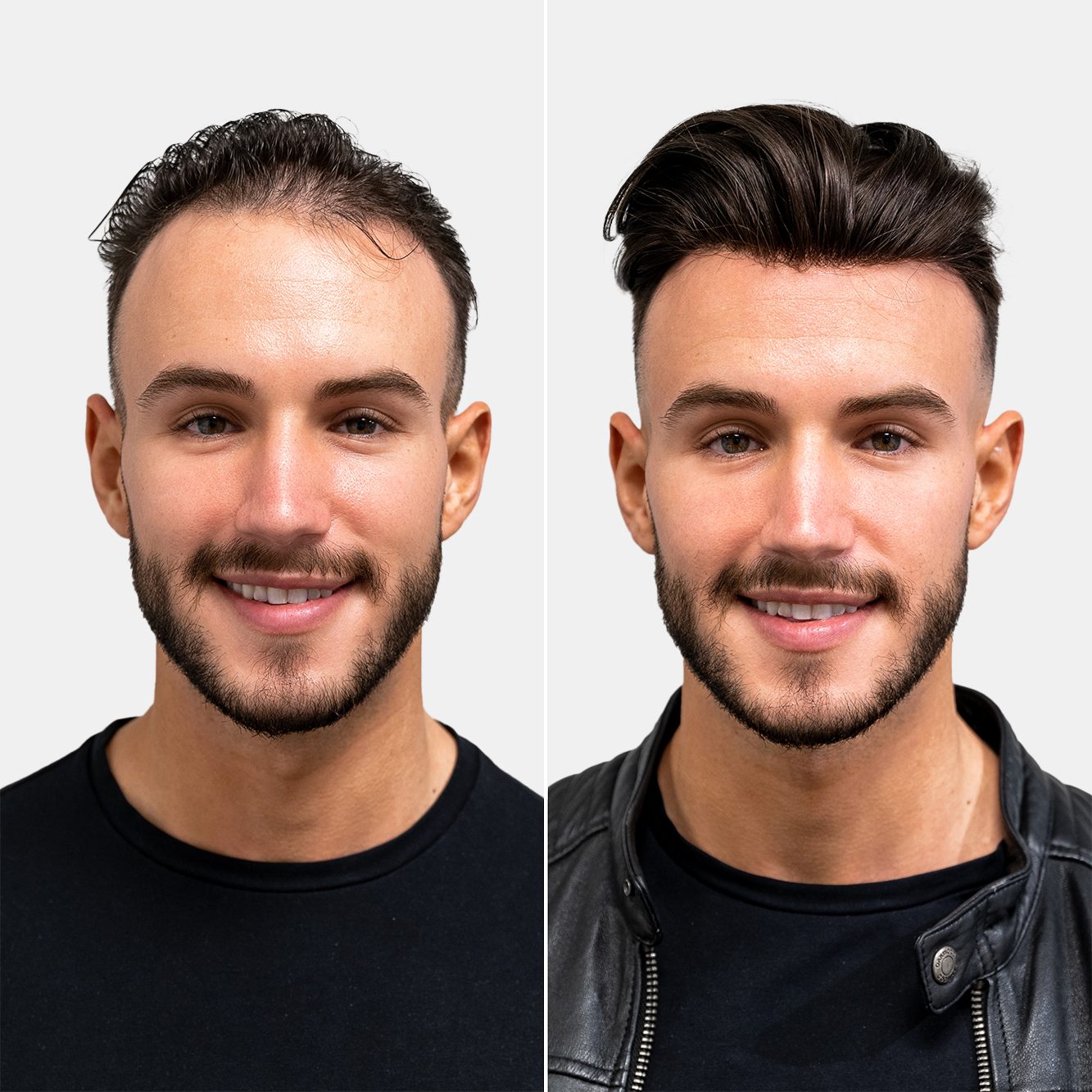 Hair Replacement System for boys