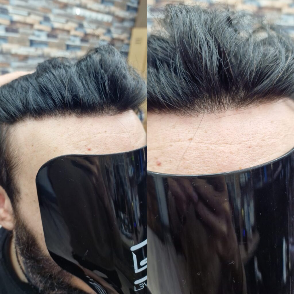 Hair system client result 1, London Hair Replacement