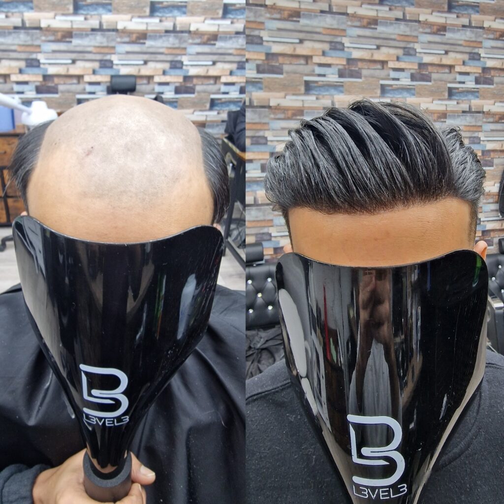 Hair system client result 11, London Hair Replacement