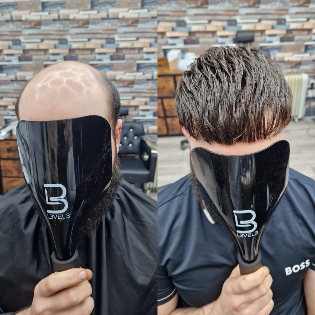 Hair system client result 15, London Hair Replacement