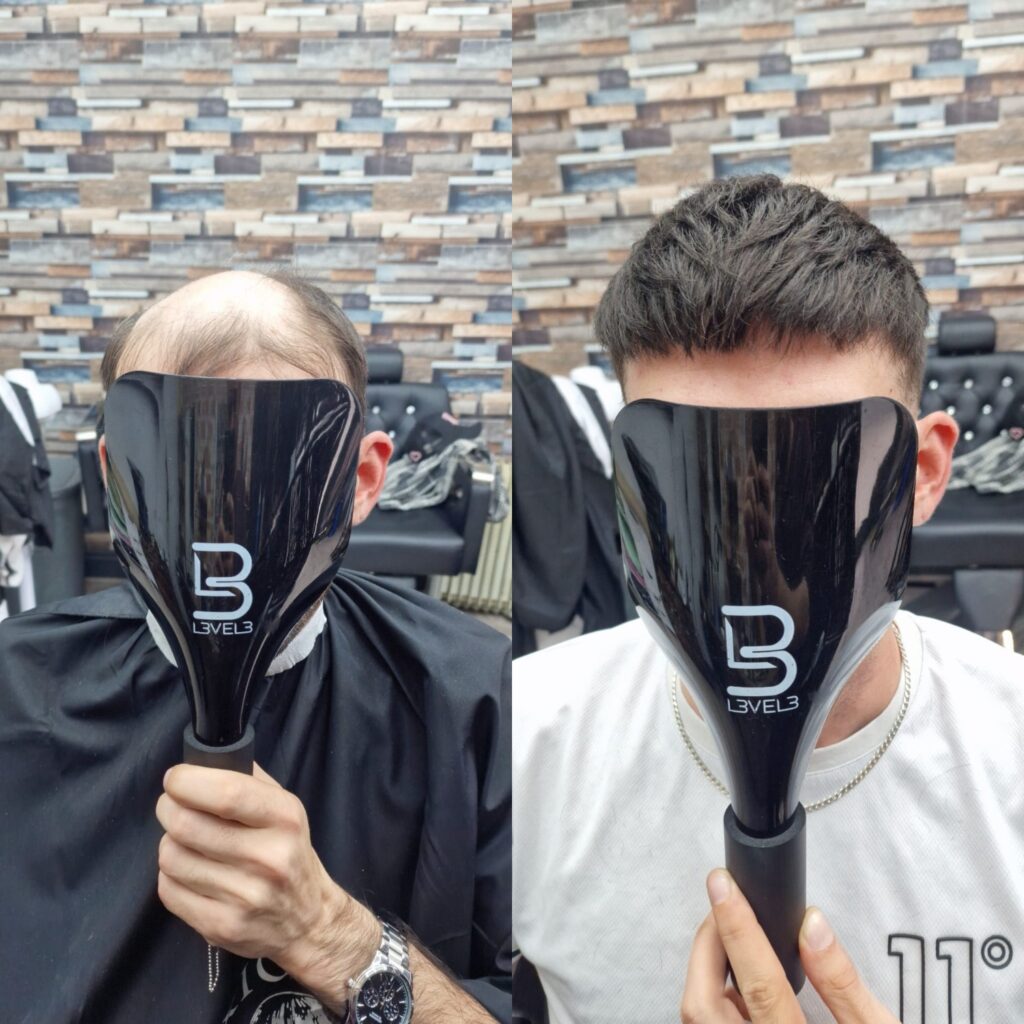 Hair system client result 16, London Hair Replacement