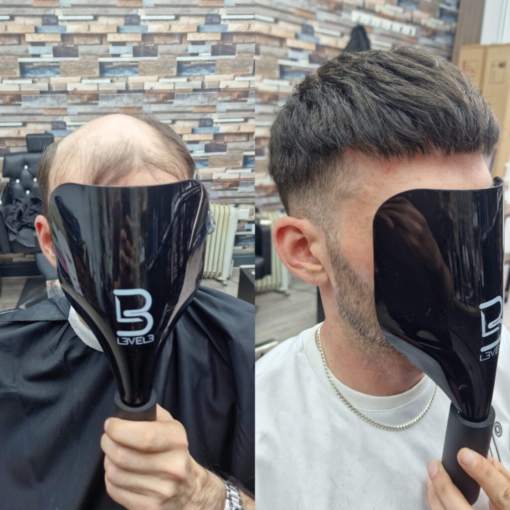 Hair system client result 17, London Hair Replacement