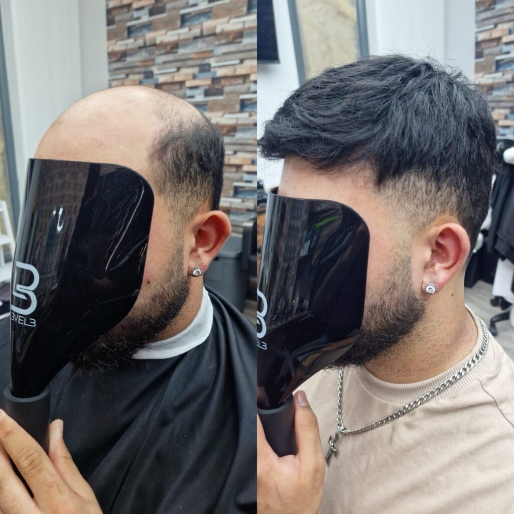 Hair system client result 19, London Hair Replacement