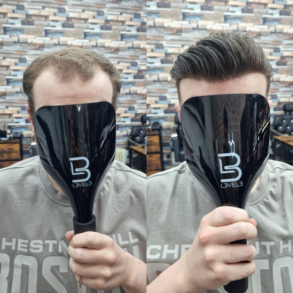 Hair system client result 2, London Hair Replacement