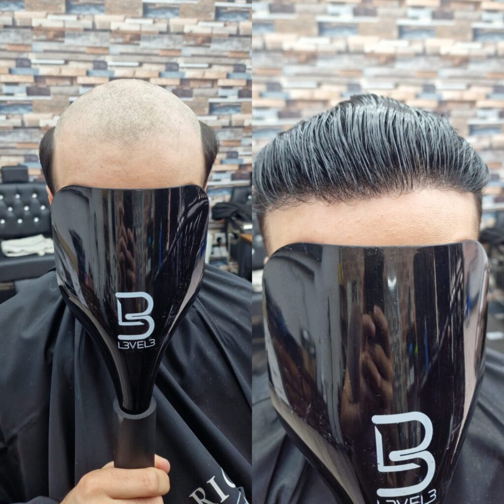 Hair system client result 3, London Hair Replacement