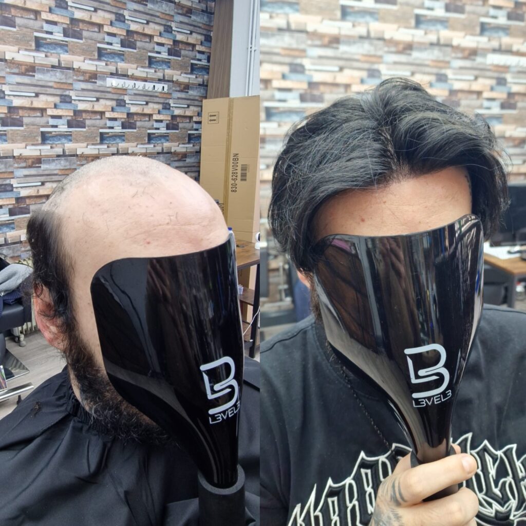 Hair system client result 8, London Hair Replacement