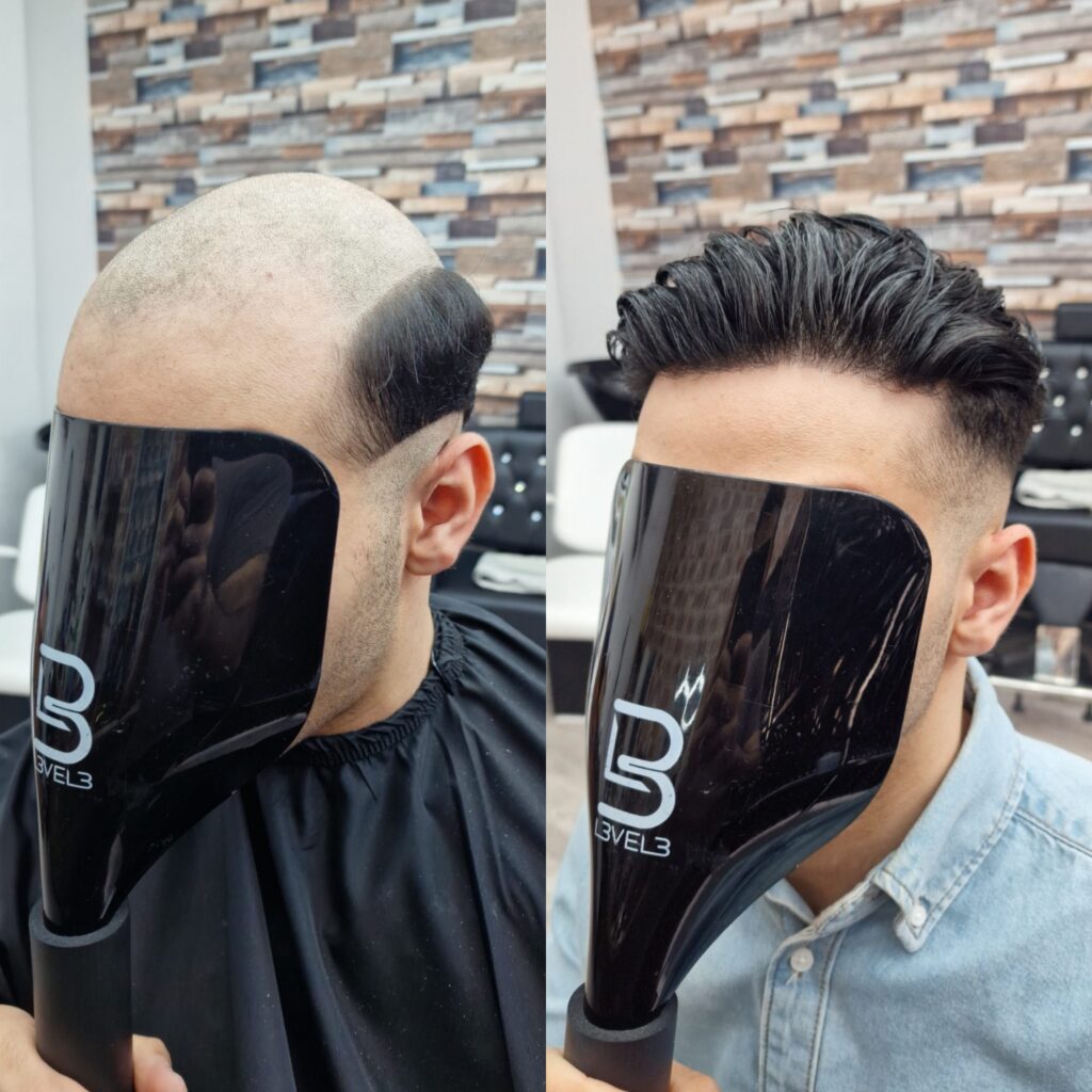 Hair system client result 9, London Hair Replacement
